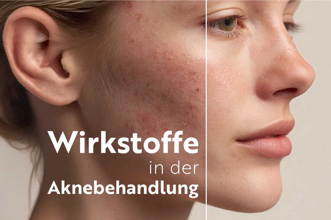 8 wirksame Wirkstoffe zur Aknebehandlung, die Sie kennen sollten