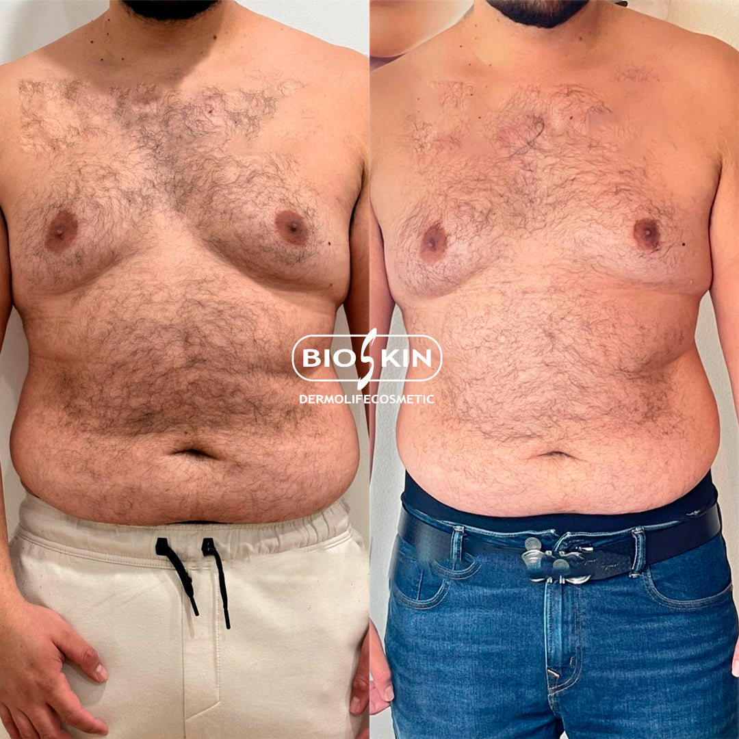 BioSkin BSK10 Lipopro 